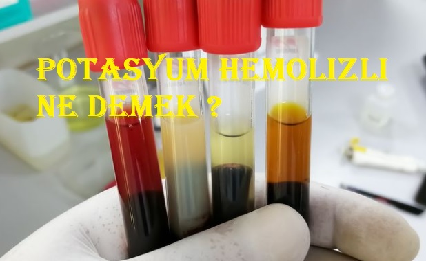 Potasyum hemolizli ne demek ?
