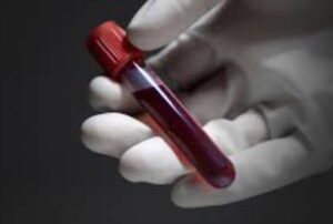 Potasyum hemolizli ne demek